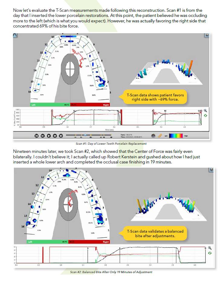 Bite Test & Adjust with Precision Tekscan